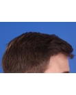 After Hair Transplant&nbsp;Front